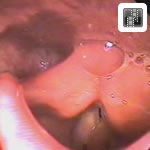 Vocal Fold Paralysis