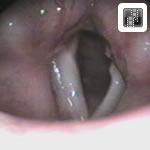 Vocal Fold Paralysis
